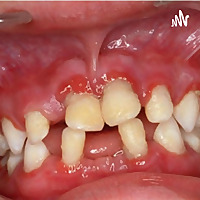 Síndrome De Papillon-lefèvre